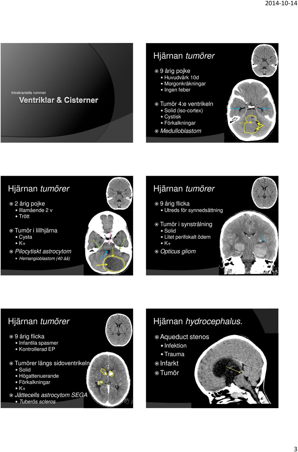 astrocytom Tumör i synstrålning Solid Litet perifokalt ödem K+ Opticus gliom Hemangioblastom (40 åå) Hjärnan tumörer Hjärnan hydrocephalus.