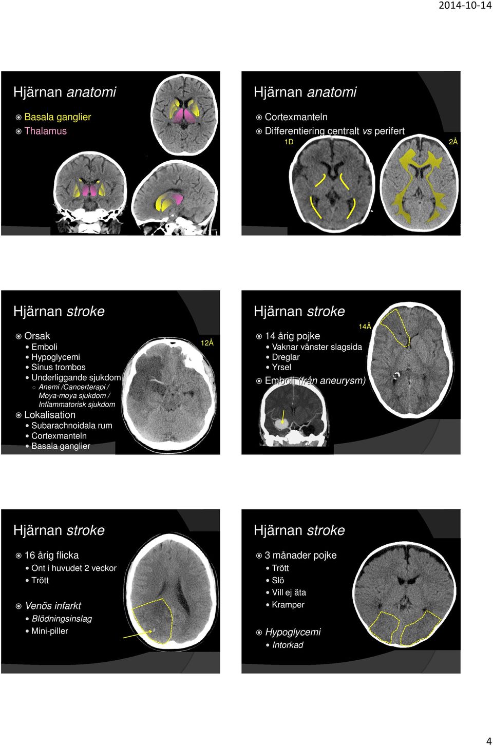 aneurysm) Moya-moya sjukdom / Inflammatorisk sjukdom Lokalisation Subarachnoidala rum Cortexmanteln Basala ganglier Hjärnan stroke Hjärnan