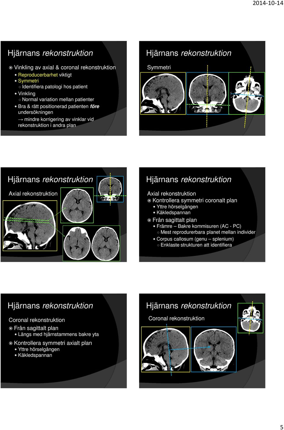 rekonstruktion Axial rekonstruktion Kontrollera symmetri coronalt plan Yttre hörselgången Käkledspannan Från sagittalt plan Främre Bakre kommisuren (AC - PC) Mest reprodurerbara planet mellan