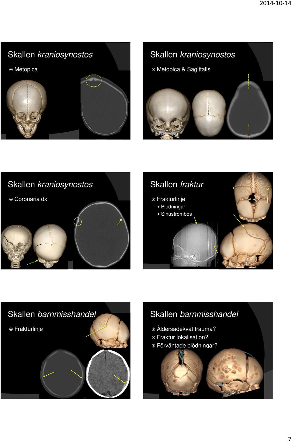 Frakturlinje Blödningar Sinustrombos Skallen barnmisshandel Frakturlinje