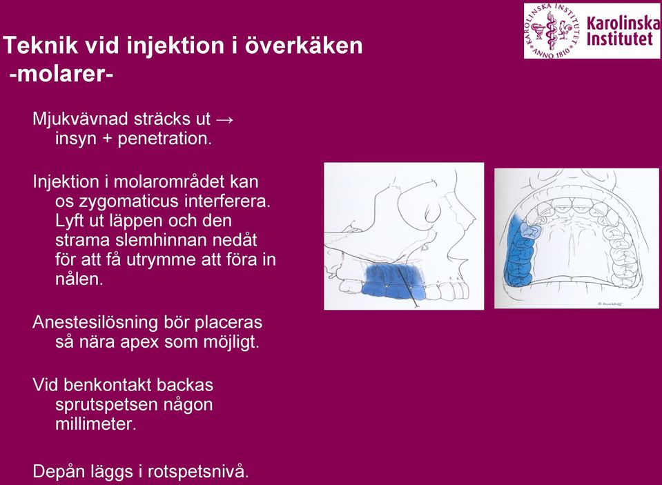 Lyft ut läppen och den strama slemhinnan nedåt för att få utrymme att föra in nålen.
