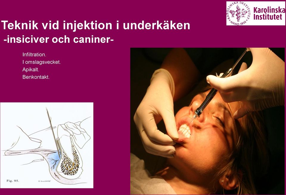 caniner- Infiltration.