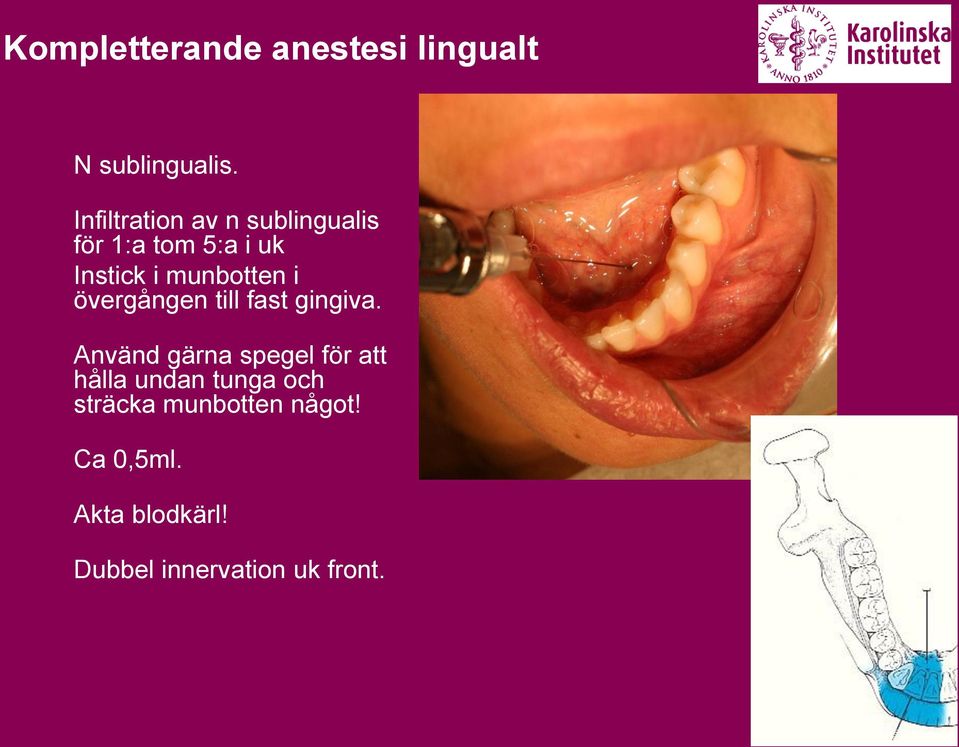 munbotten i övergången till fast gingiva.