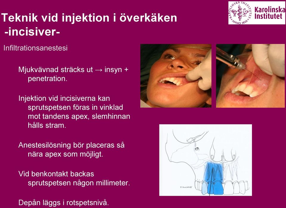 Injektion vid incisiverna kan sprutspetsen föras in vinklad mot tandens apex,