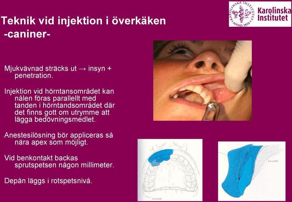 det finns gott om utrymme att lägga bedövningsmedlet.