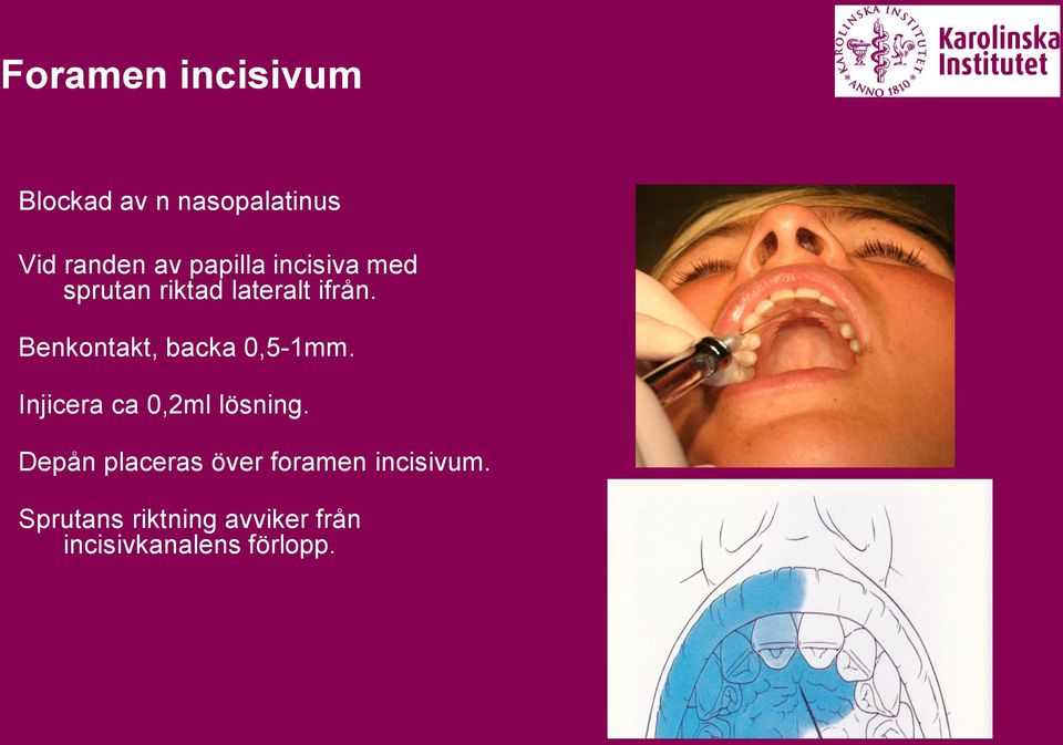 Benkontakt, backa 0,5-1mm. Injicera ca 0,2ml lösning.