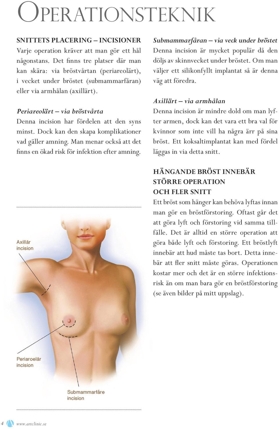 Periareolärt via bröstvårta Denna incision har fördelen att den syns minst. Dock kan den skapa komplikationer vad gäller amning. Man menar också att det finns en ökad risk för infektion efter amning.