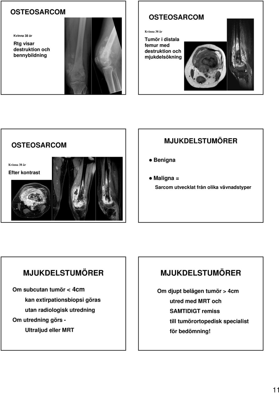 MJUKDELSTUMÖRER Om subcutan tumör < 4cm kan extirpationsbiopsi göras utan radiologisk utredning Om utredning görs - Ultraljud eller