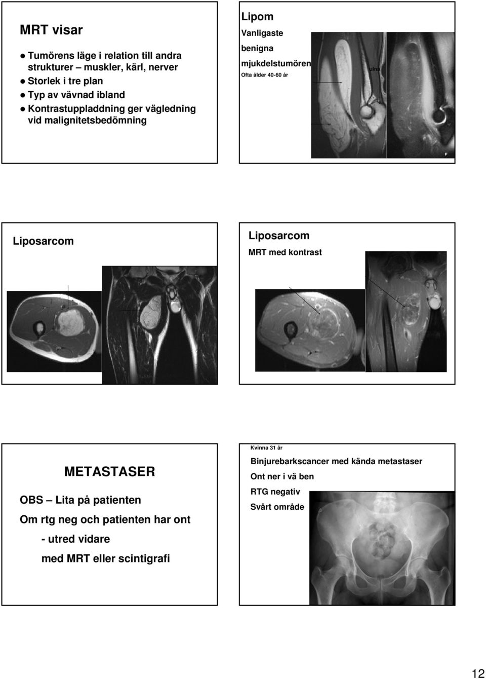 ulna Liposarcom Liposarcom MRT med kontrast Kvinna 31 år METASTASER OBS Lita på patienten Om rtg neg och patienten har