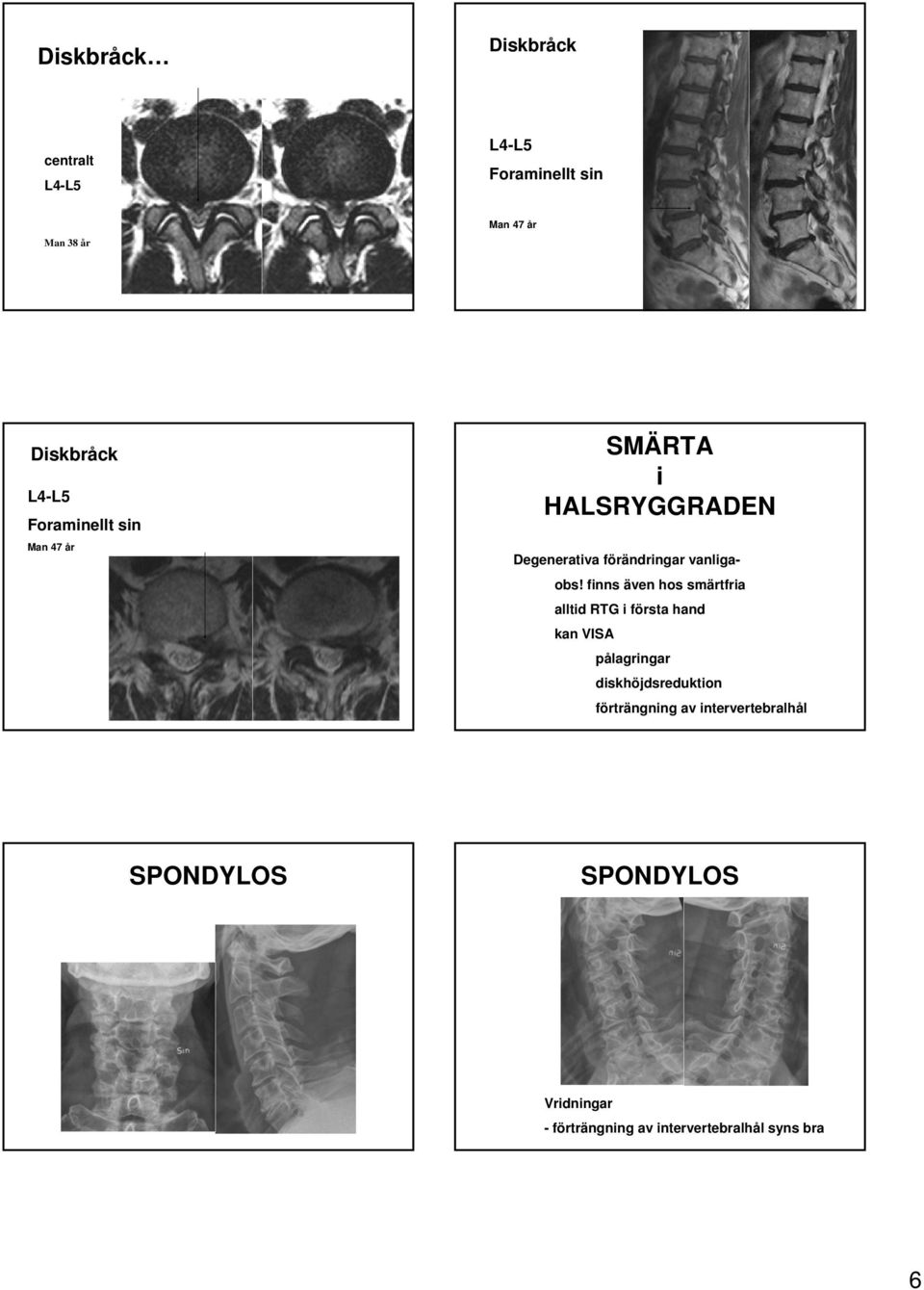 finns även hos smärtfria alltid RTG i första hand kan VISA pålagringar diskhöjdsreduktion