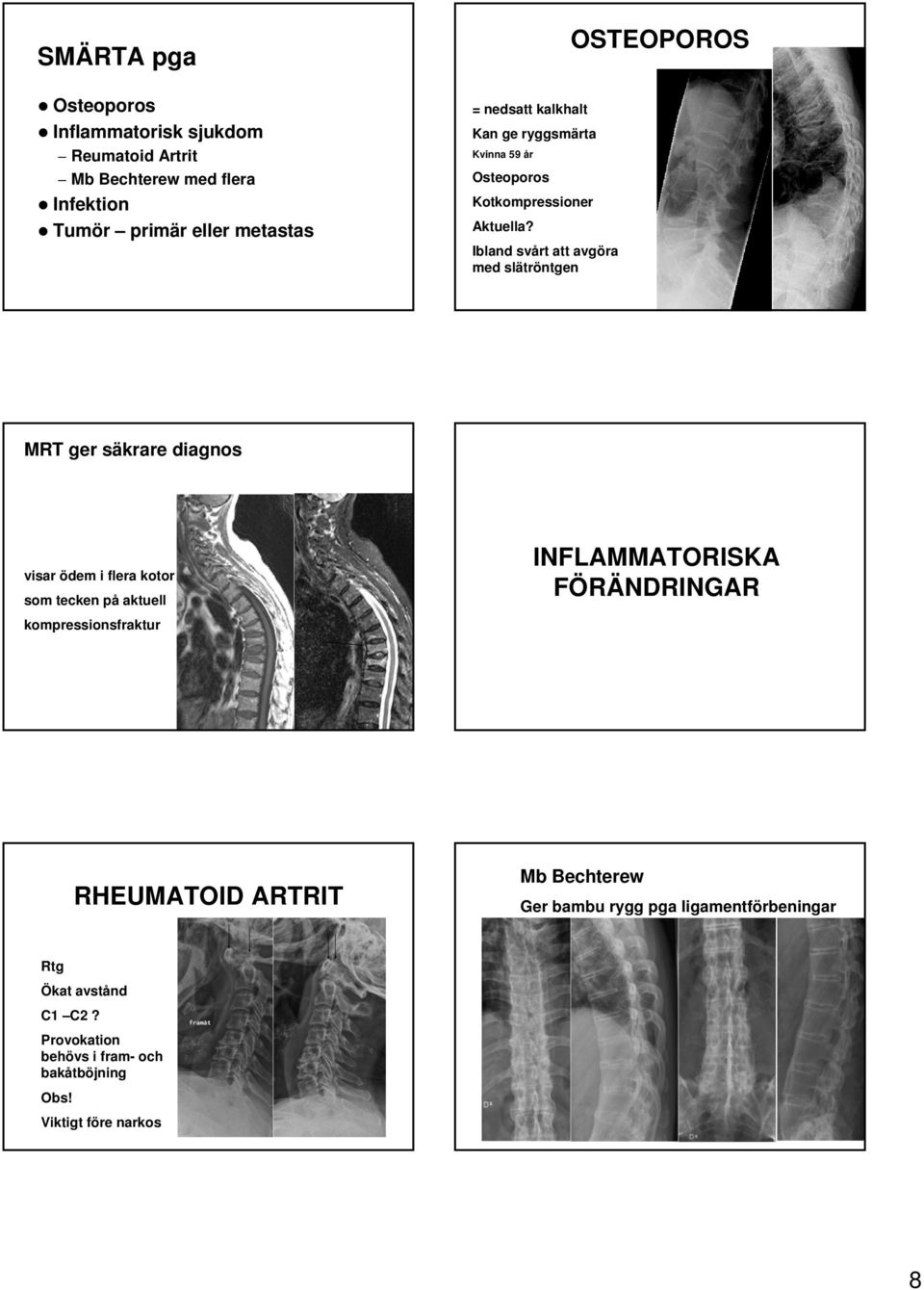 Ibland svårt att avgöra med slätröntgen OSTEOPOROS MRT ger säkrare diagnos visar ödem i flera kotor som tecken på aktuell