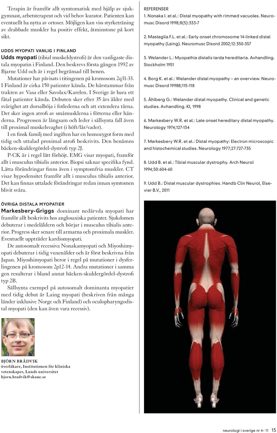 Udds myopati vanlig i Finland Udds myopati (tibial muskeldystrofi) är den vanligaste distala myopatin i Finland. Den beskrevs första gången 1992 av Bjarne Udd och är i regel begränsad till benen.