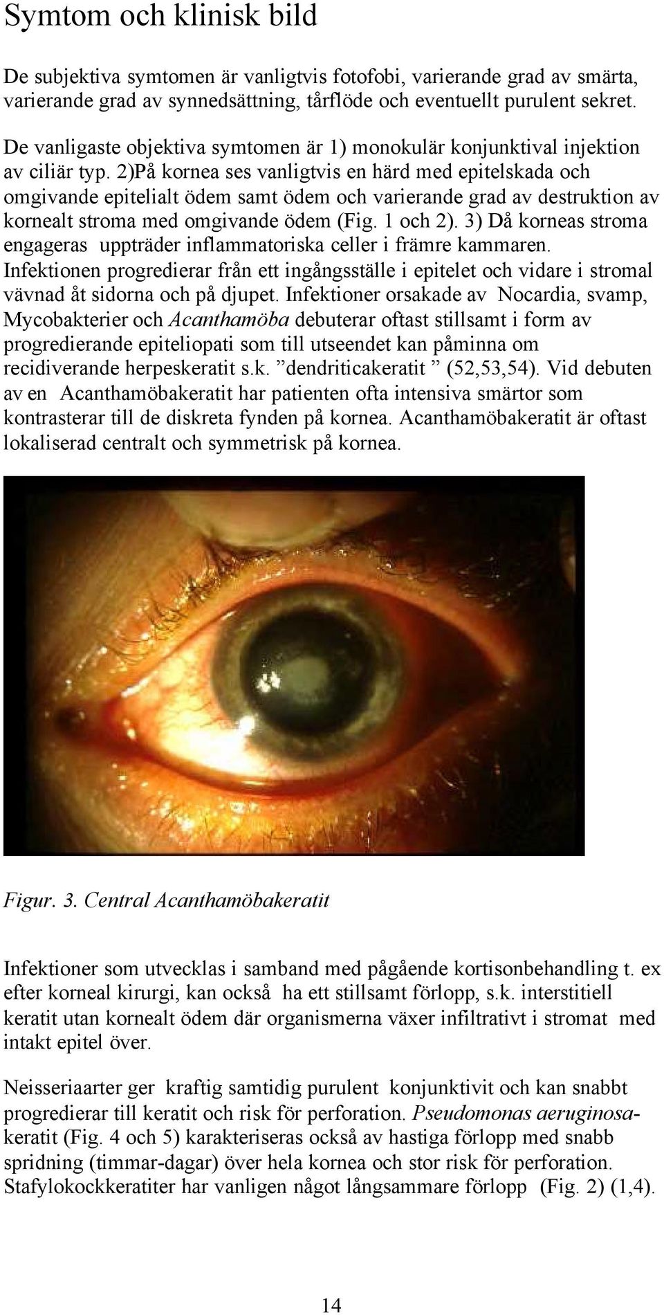 2)På kornea ses vanligtvis en härd med epitelskada och omgivande epitelialt ödem samt ödem och varierande grad av destruktion av kornealt stroma med omgivande ödem (Fig. 1 och 2).