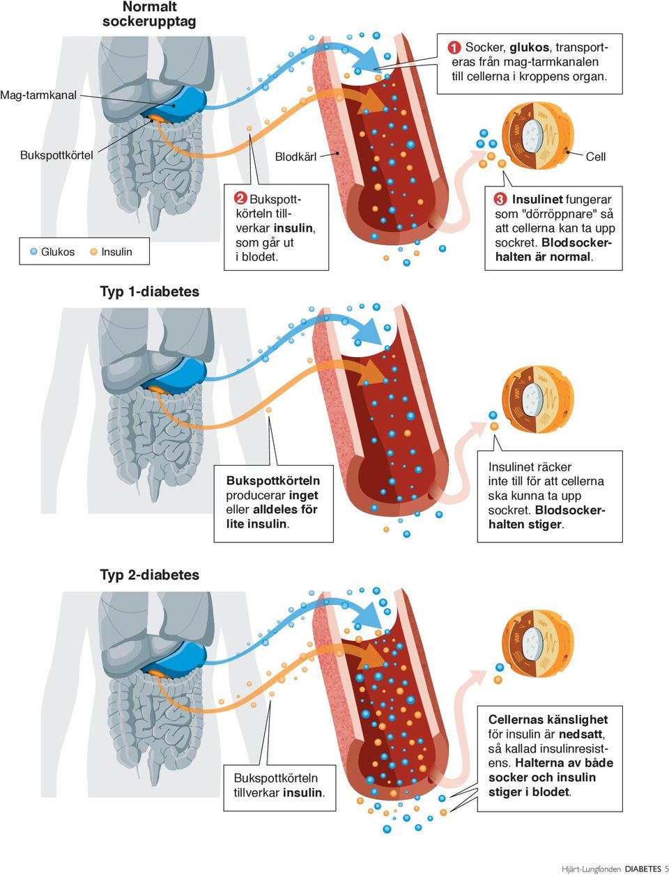 Blodsockerhalten är normal. Typ 1-diabetes Bukspottkörteln producerar inget eller alldeles för lite insulin.