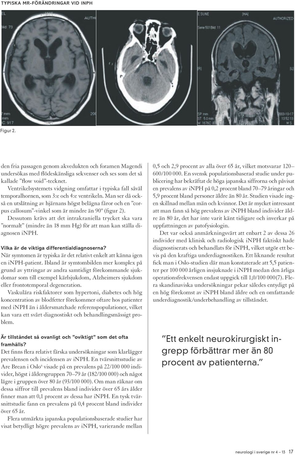 Man ser då också en utslätning av hjärnans högst belägna fåror och en corpus callosum -vinkel som är mindre än 90º (figur 2).