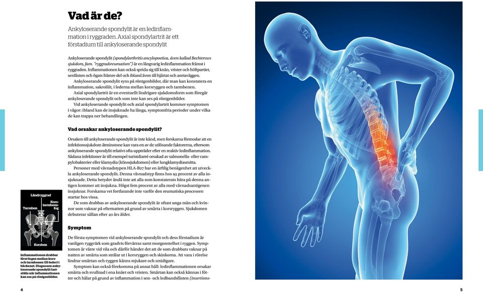 ryggradsreumatism ) är en långvarig ledinflammation främst i ryggraden.