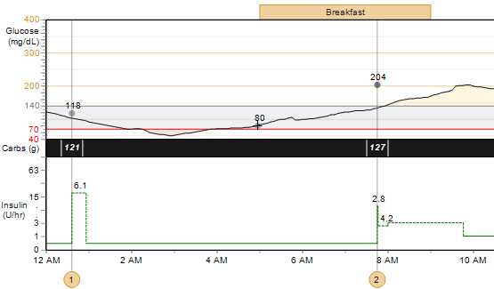 Glukos, kolhydrater och insulin Kurvan visar en översikt över patientens glukosnivåer, kolhydratintag samt insulinanvändning under den valda dagen.