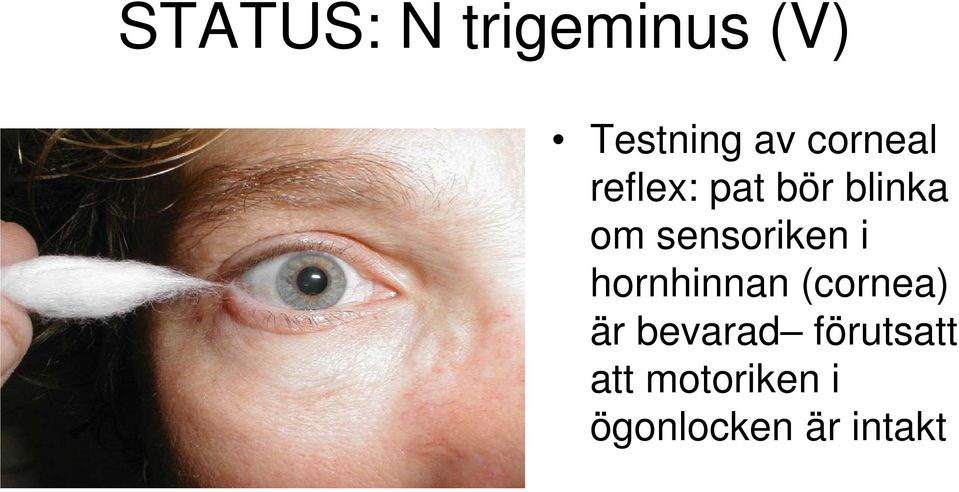 sensoriken i hornhinnan (cornea) är