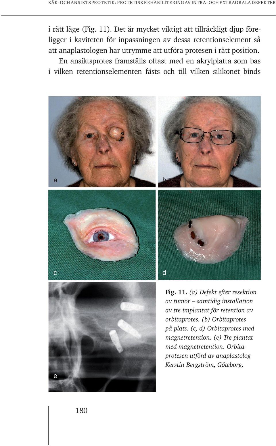 En ansiktsprotes framställs oftast med en akrylplatta som bas i vilken retentionselementen fästs och till vilken silikonet binds a b c d Fig. 11.