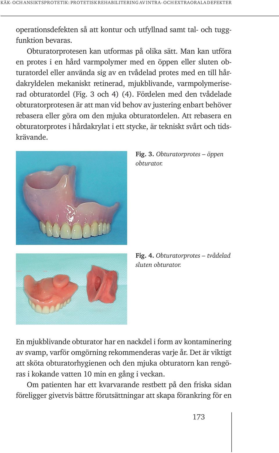 varmpolymeriserad obturatordel (Fig. 3 och 4) (4). Fördelen med den tvådelade obturatorprotesen är att man vid behov av justering enbart behöver rebasera eller göra om den mjuka obturatordelen.