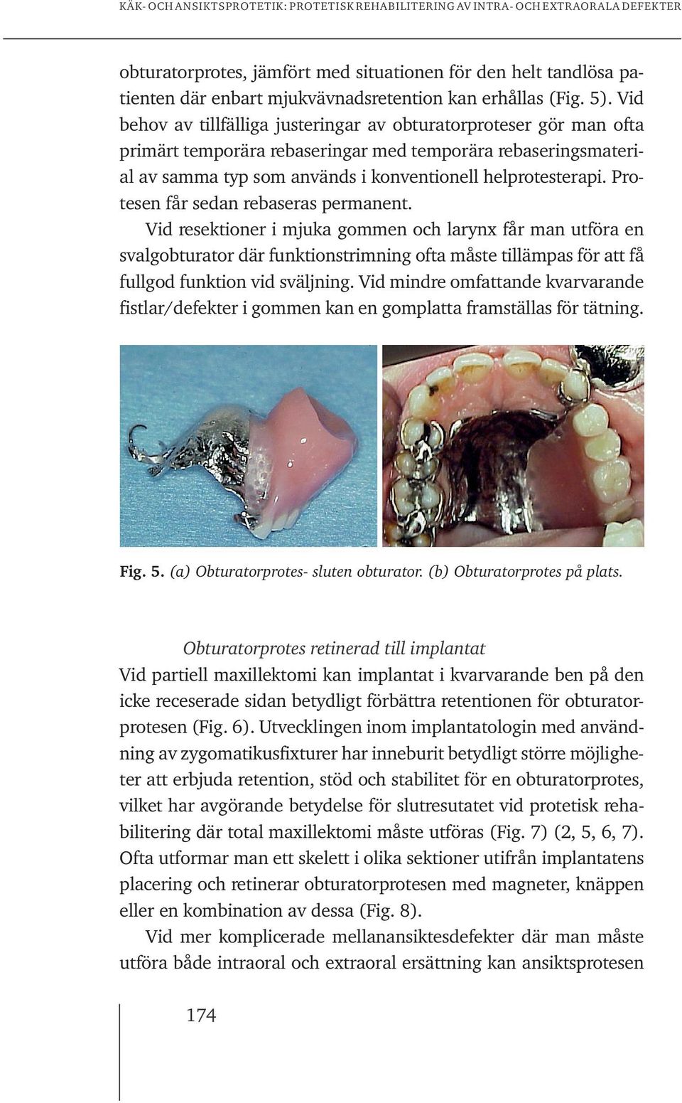 Protesen får sedan rebaseras permanent. Vid resektioner i mjuka gommen och larynx får man utföra en svalgobturator där funktionstrimning ofta måste tillämpas för att få fullgod funktion vid sväljning.