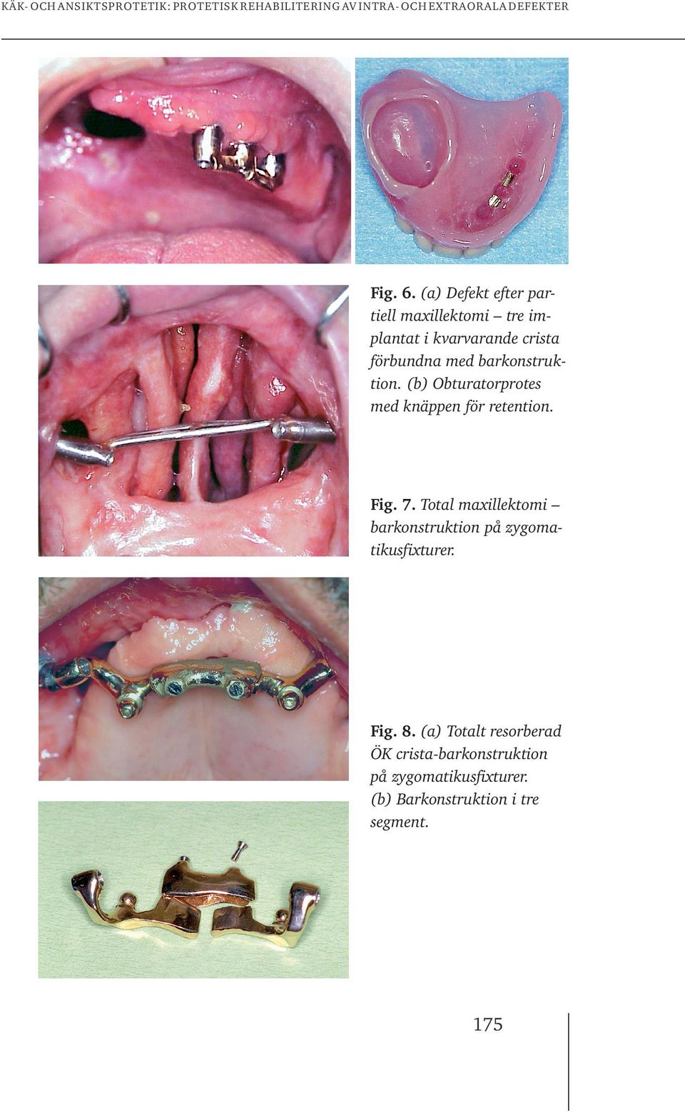 med barkonstruktion. (b) Obturatorprotes med knäppen för retention. Fig. 7.