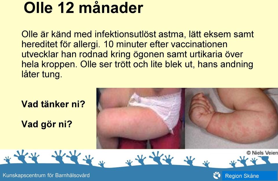 10 minuter efter vaccinationen utvecklar han rodnad kring ögonen samt