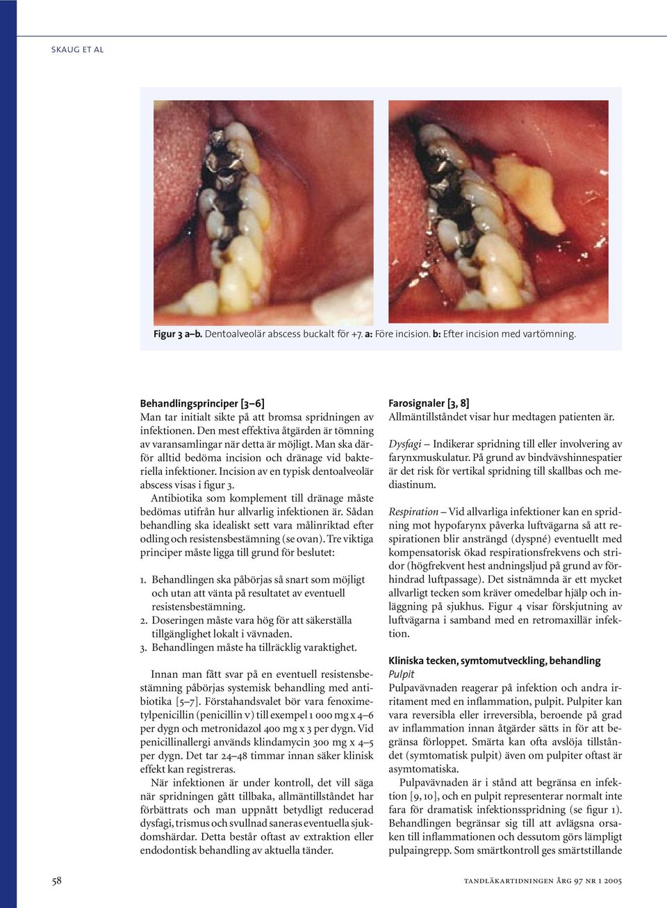 Man ska därför alltid bedöma incision och dränage vid bakteriella infektioner. Incision av en typisk dentoalveolär abscess visas i figur 3.