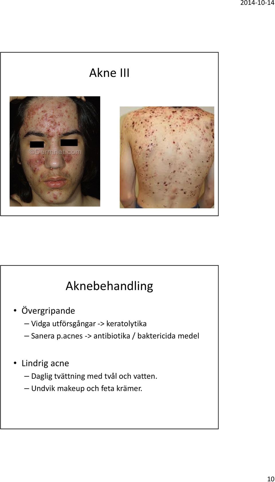 acnes-> antibiotika / baktericida medel Lindrig