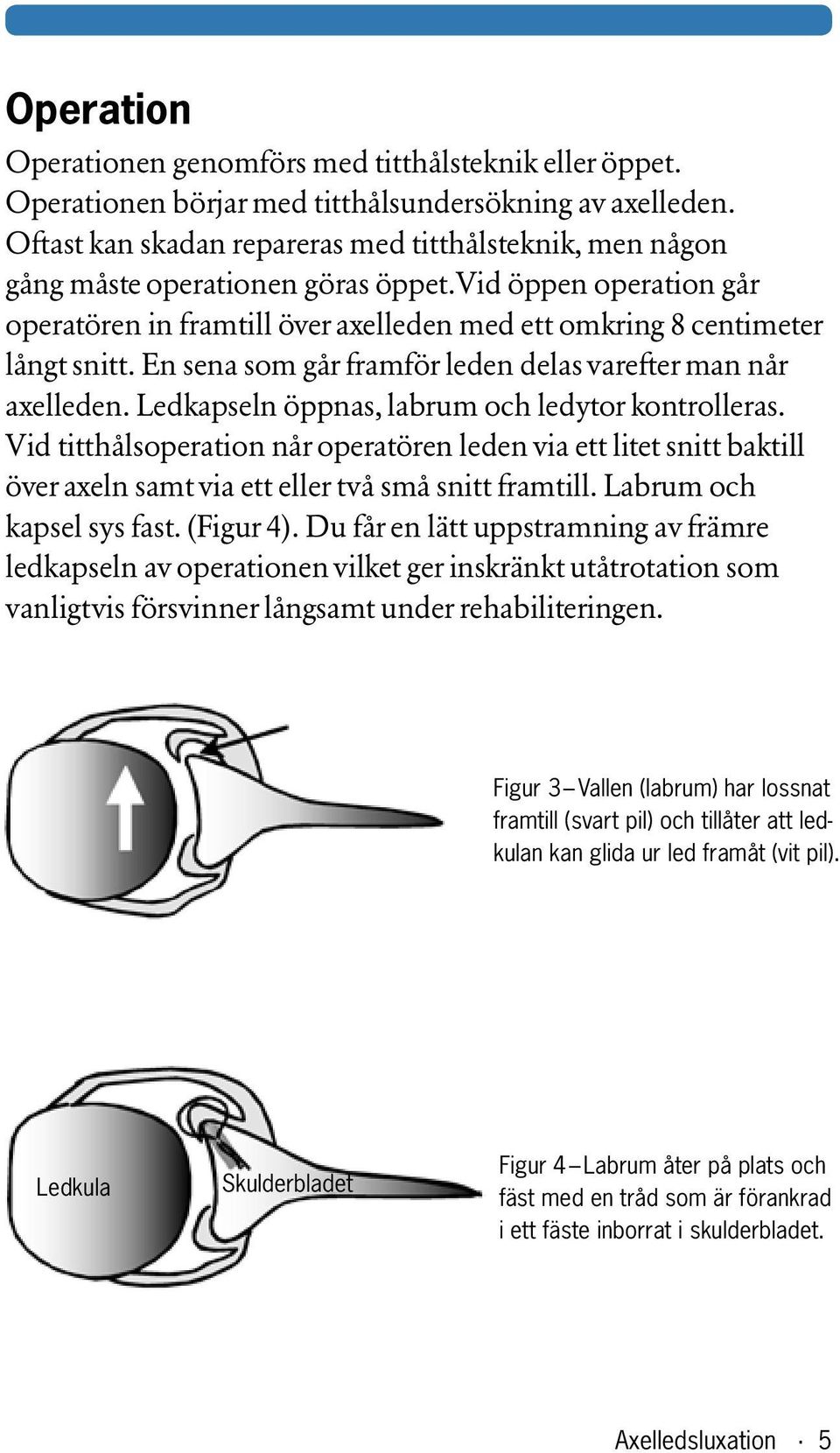 En sena som går framför leden delas varefter man når axelleden. Ledkapseln öppnas, labrum och ledytor kon trolleras.