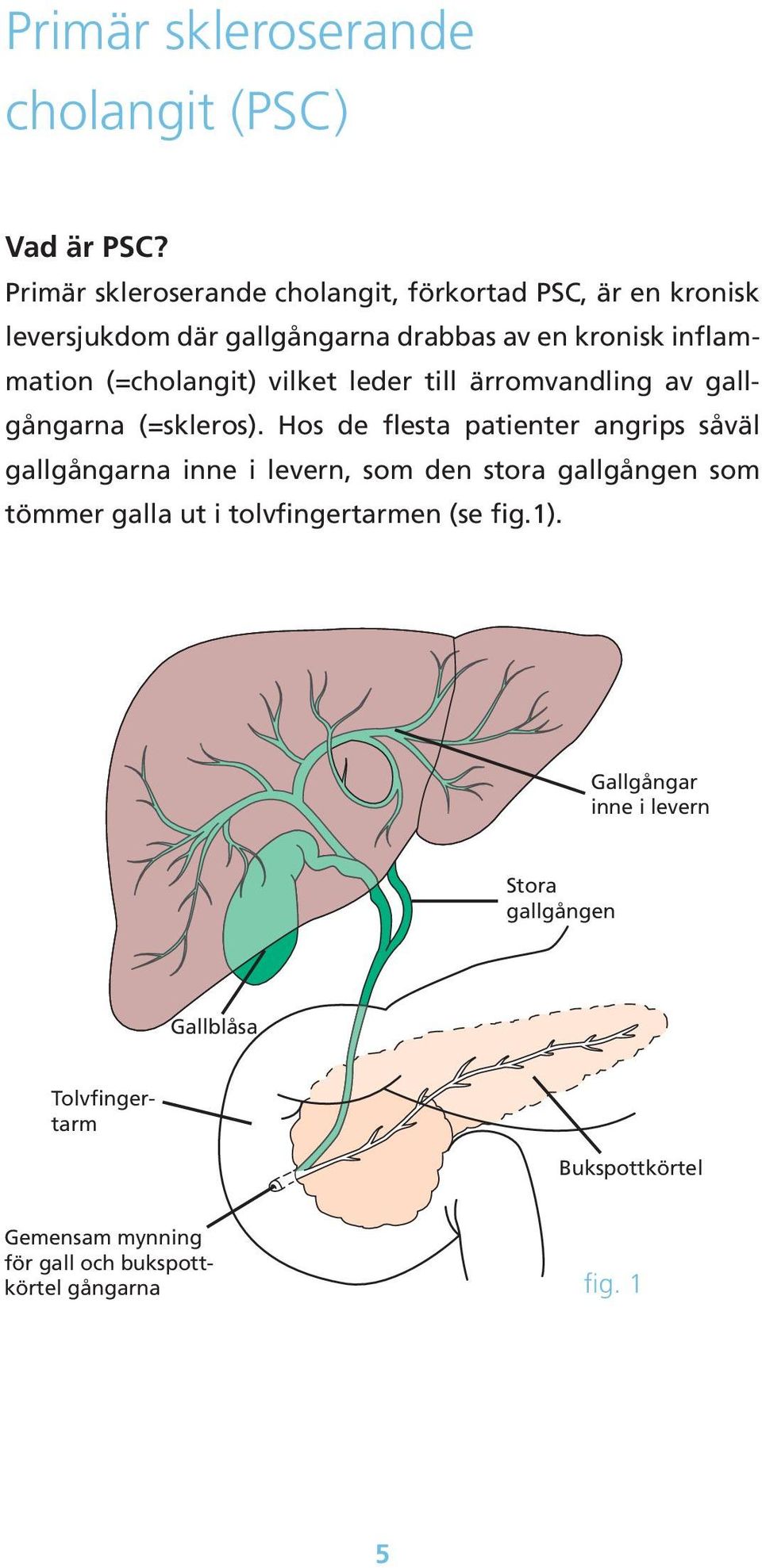 (=cholangit) vilket leder till ärromvandling av gallgångarna (=skleros).