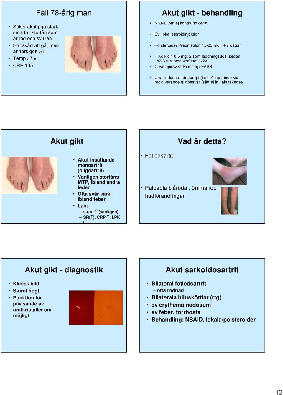 Urat-reducerande terapi (t.ex. Allopurinol) vid recidiverande giktbesvär (sätt ej in i akutskede!