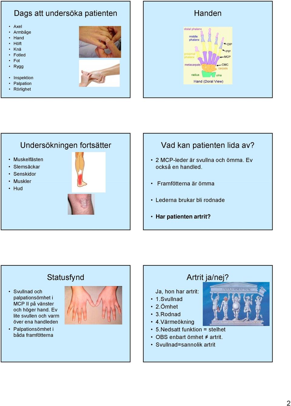 Framfötterna är ömma Lederna brukar bli rodnade Har patienten artrit? Svullnad och palpationsömhet i MCP II på vänster och höger hand.