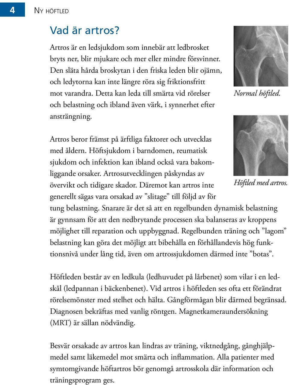 Detta kan leda till smärta vid rörelser och belastning och ibland även värk, i synnerhet efter ansträngning. Normal höftled. Artros beror främst på ärftliga faktorer och utvecklas med åldern.