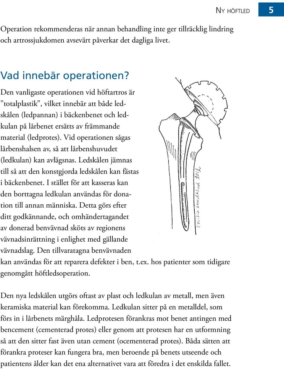 Vid operationen sågas lårbenshalsen av, så att lårbenshuvudet (ledkulan) kan avlägsnas. Ledskålen jämnas till så att den konstgjorda ledskålen kan fästas i bäckenbenet.