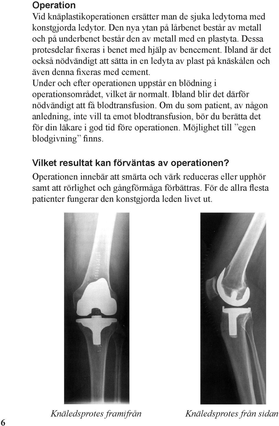 Under och efter operationen uppstår en blödning i operationsområdet, vilket är normalt. Ibland blir det därför nödvändigt att få blodtransfusion.