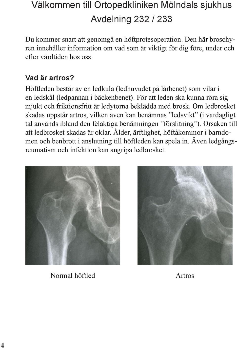 Höftleden består av en ledkula (ledhuvudet på lårbenet) som vilar i en ledskål (ledpannan i bäckenbenet). För att leden ska kunna röra sig mjukt och friktionsfritt är ledytorna beklädda med brosk.