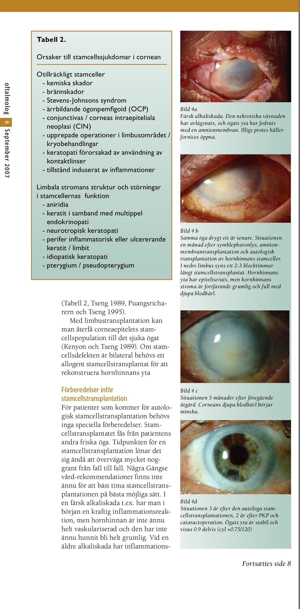 conjunctivas / corneas intraepiteliala neoplasi (CIN) - upprepade operationer i limbusområdet / kryobehandlingar - keratopati förorsakad av användning av kontaktlinser - tillstånd induserat av