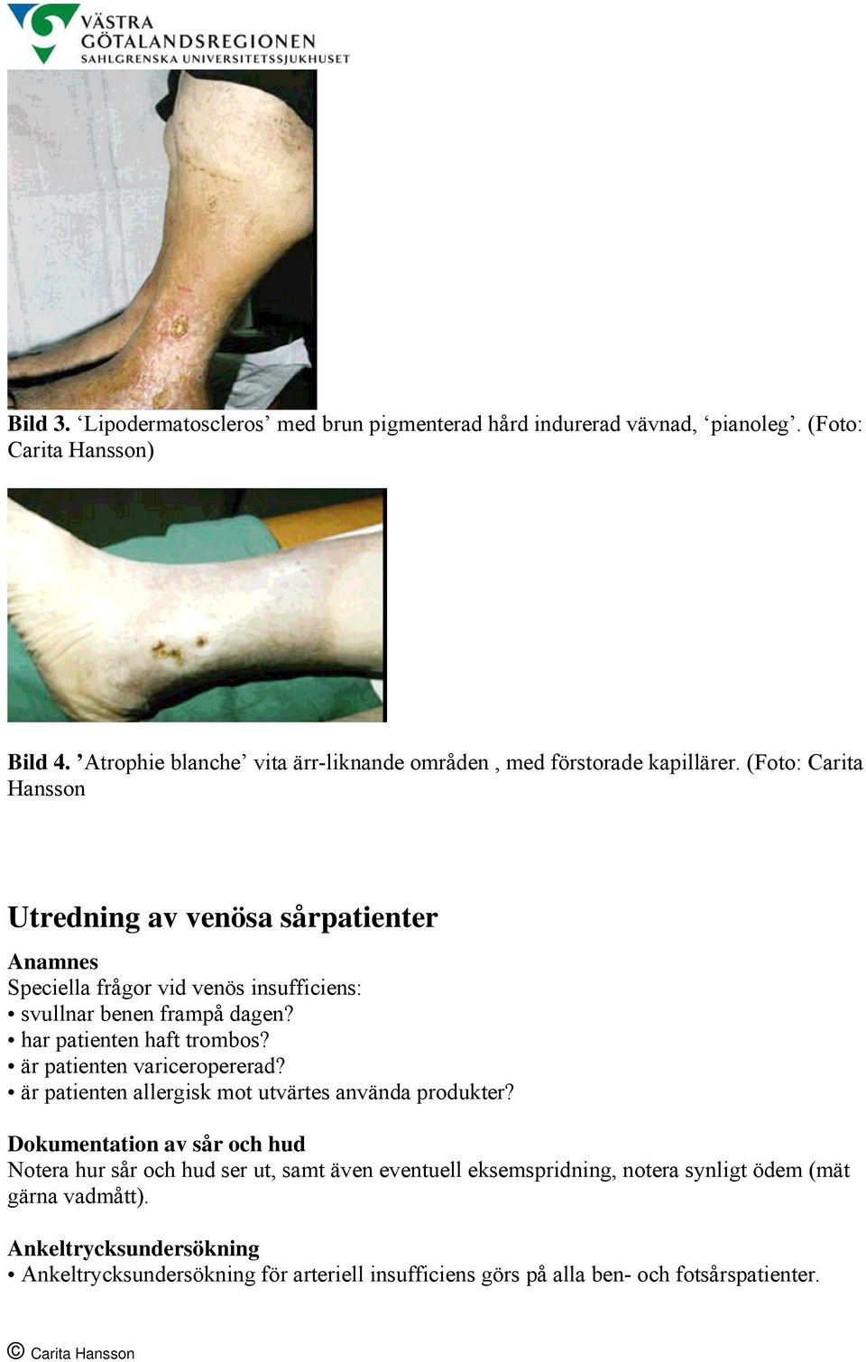 (Foto: Carita Hansson Utredning av venösa sårpatienter Anamnes Speciella frågor vid venös insufficiens: svullnar benen frampå dagen? har patienten haft trombos?