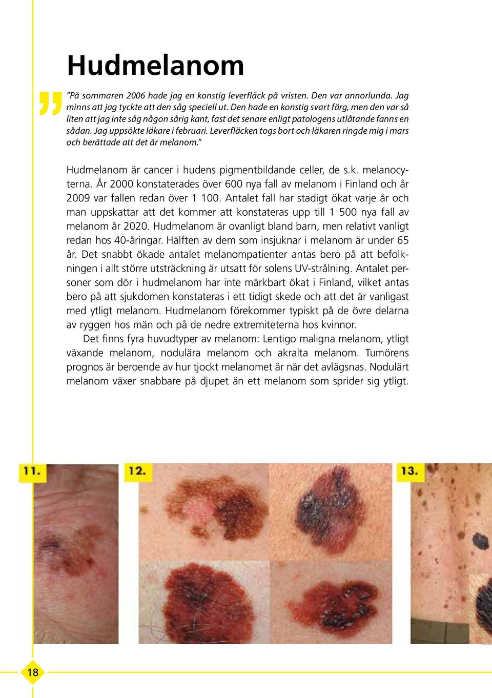 Leverfläcken togs bort och läkaren ringde mig i mars och berättade att det är melanom. Hudmelanom är cancer i hudens pigmentbildande celler, de s.k. melanocyterna.