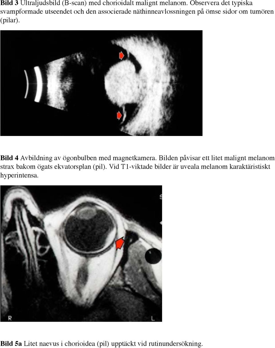 (pilar). Bild 4 Avbildning av ögonbulben med magnetkamera.