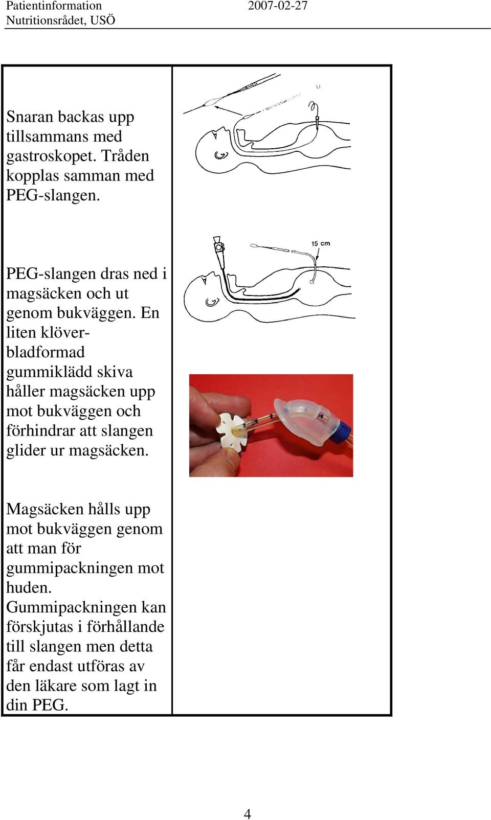 En liten klöverbladformad gummiklädd skiva håller magsäcken upp mot bukväggen och förhindrar att slangen glider ur