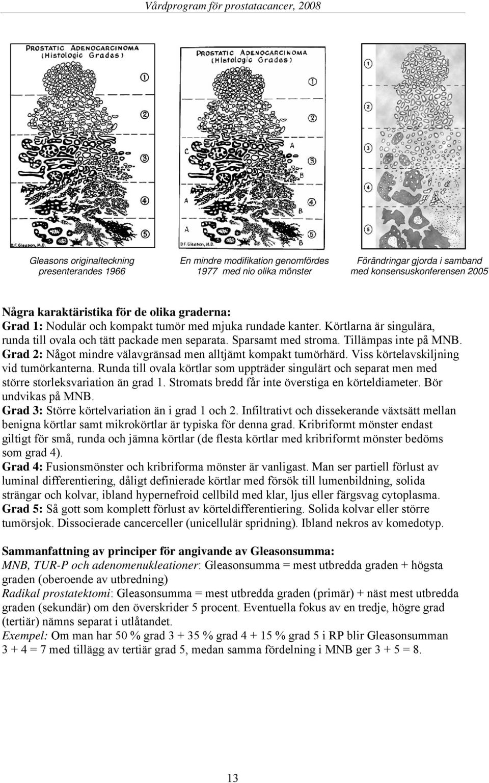 Grad 2: Något mindre välavgränsad men alltjämt kompakt tumörhärd. Viss körtelavskiljning vid tumörkanterna.