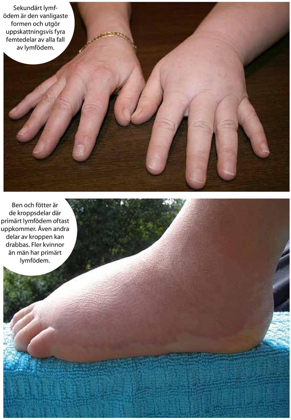 Ben och fötter är de kroppsdelar där primärt lymfödem oftast