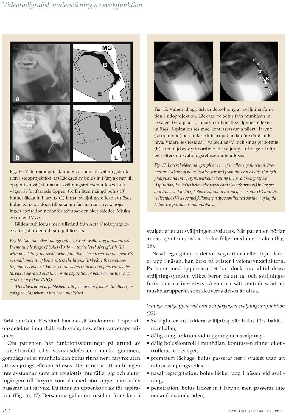 (b) En liten mängd bolus () hinner läcka in i larynx (L) innan sväljningsreflexen utlöses. olus passerar dock tillbaka in i farynx när larynx höjs, ingen aspiration nedanför stämbanden sker således.