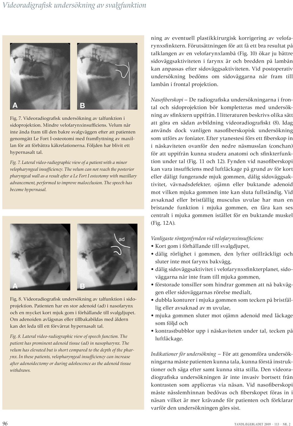 Vid postoperativ undersökning bedöms om sidoväggarna når fram till lambån i frontal projektion. Fig. 7. Videoradiografisk undersökning av talfunktion i sidoprojektion. Mindre velofarynxinsufficiens.
