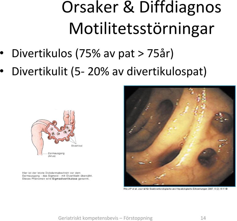 av pat > 75år) Divertikulit (5 20% av