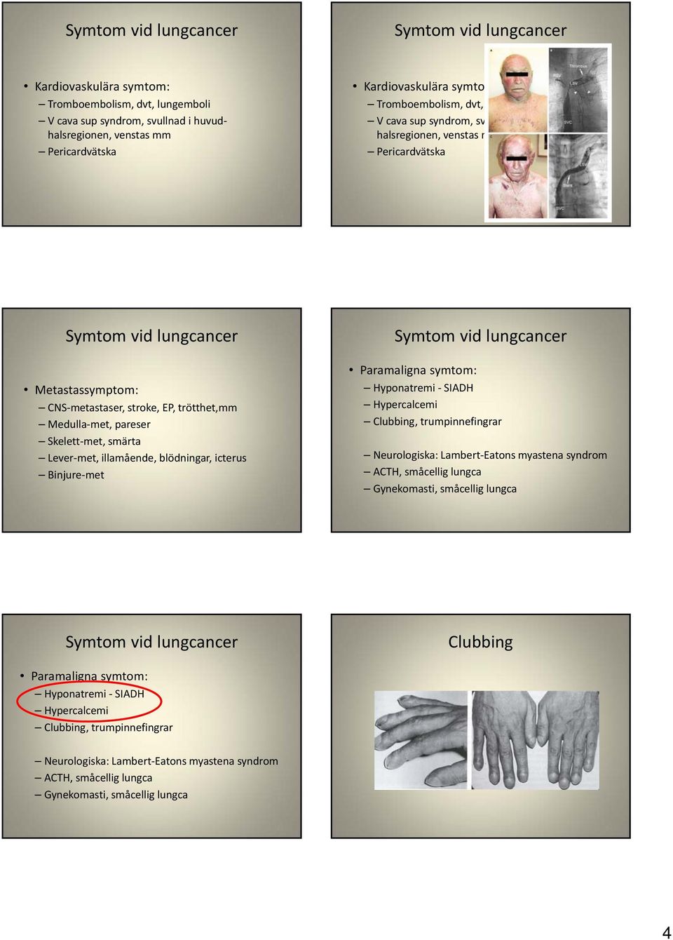 blödningar, icterus Binjure met Paramaligna symtom: Hyponatremi SIADH Hypercalcemi Clubbing, trumpinnefingrar Neurologiska: Lambert Eatons myastena syndrom ACTH, småcellig lungca Gynekomasti,