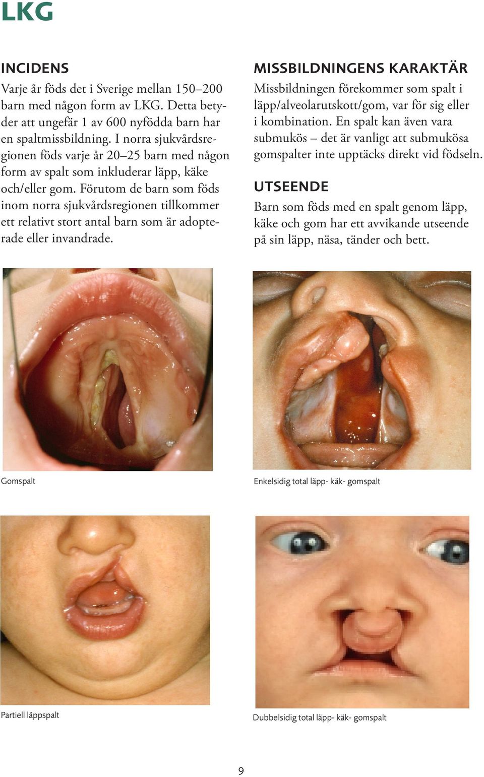 Detta, i kombination med minskad i Missbildningen Missbildningen förekommer förekommer som som spalt spalt i läpp/alveolarutskott/gom, tillväxt av överkäken, leder var var för i de för sig flesta sig