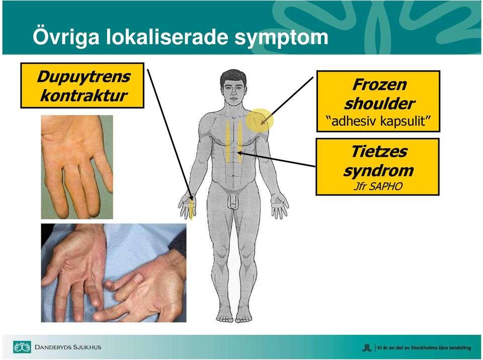 kontraktur Frozen shoulder